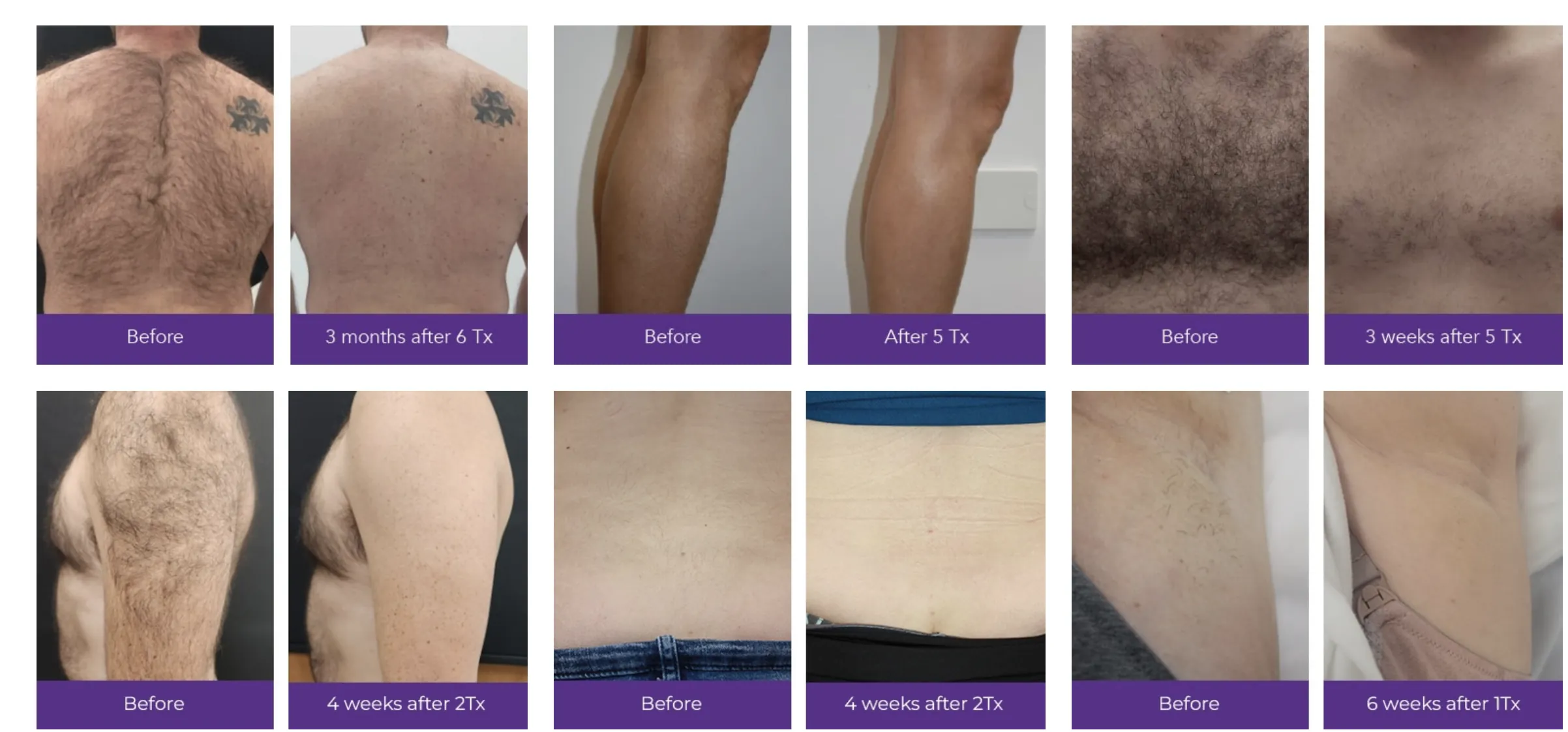 Laser hair removal before and after results compared to waxing